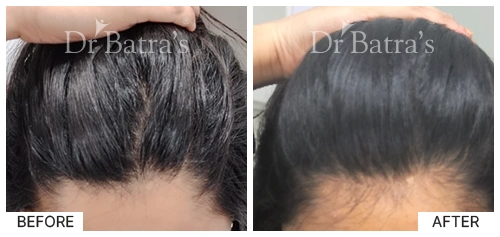 Hair Falling Treatment